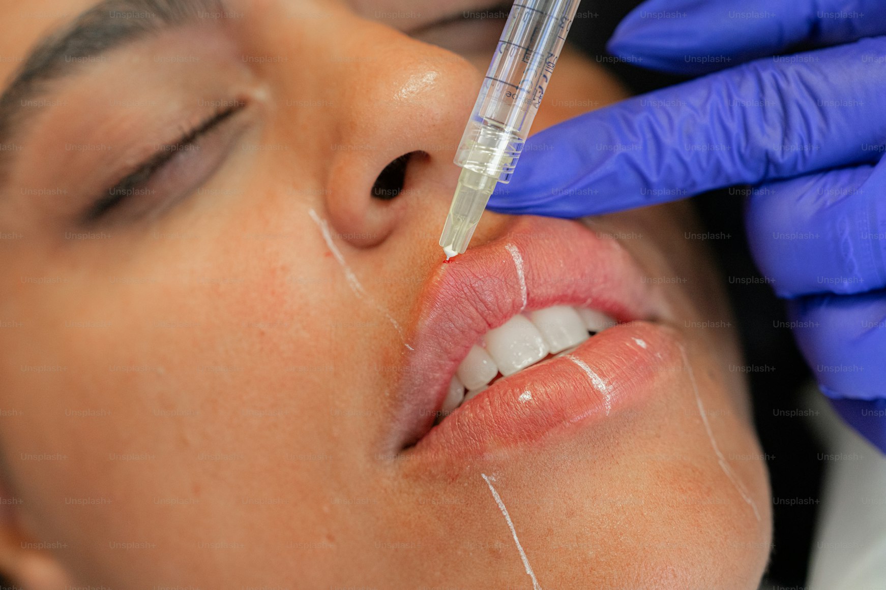 Dermal Fillers