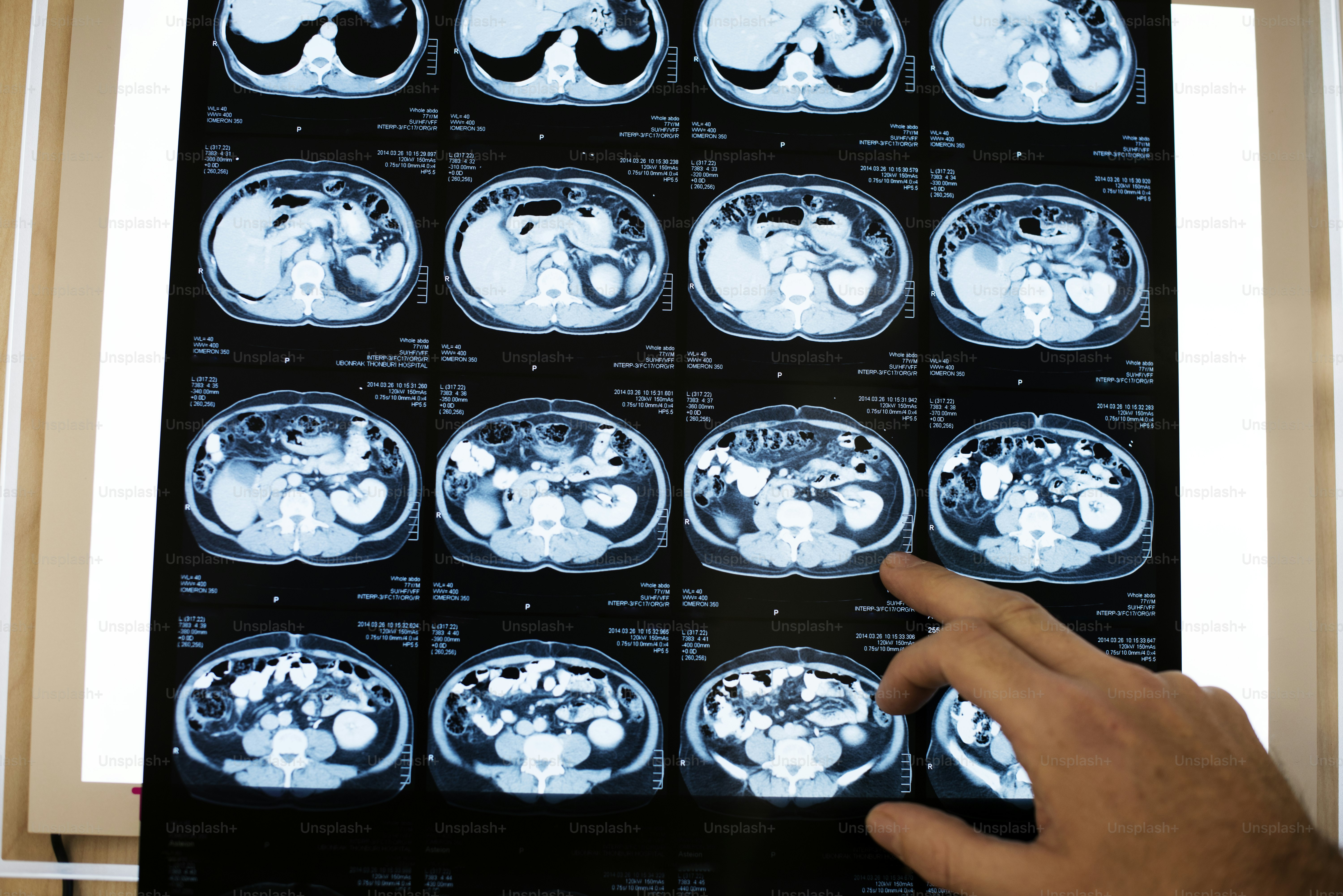 Brain CT scan x-ray film