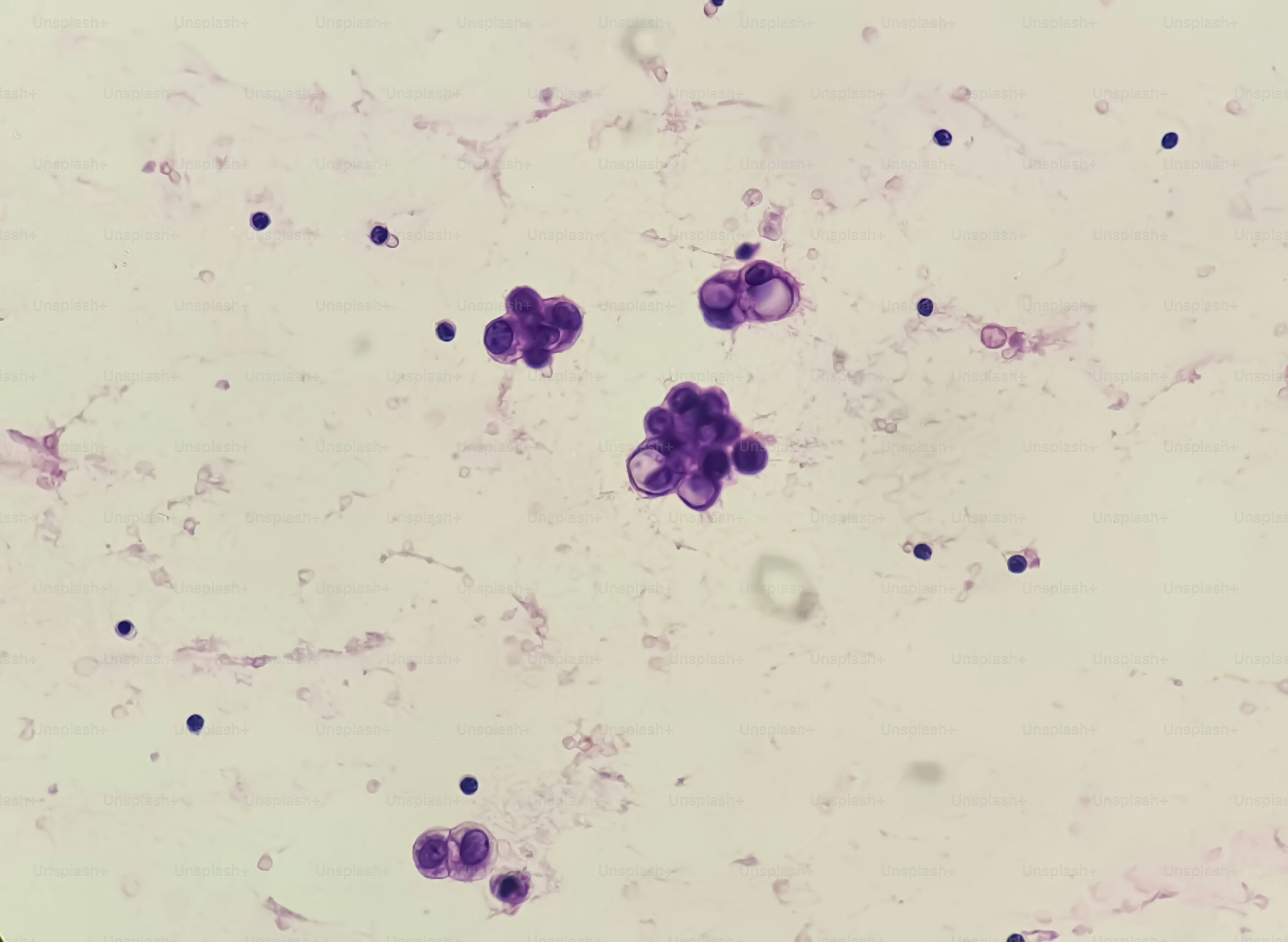 Malignant fluid cytology; Cells of adenocarcinoma may spread to fluid of pleural or peritoneal cavity in cancer from the breast, lung, colon, pancreas, ovary, endometrium or other sites.