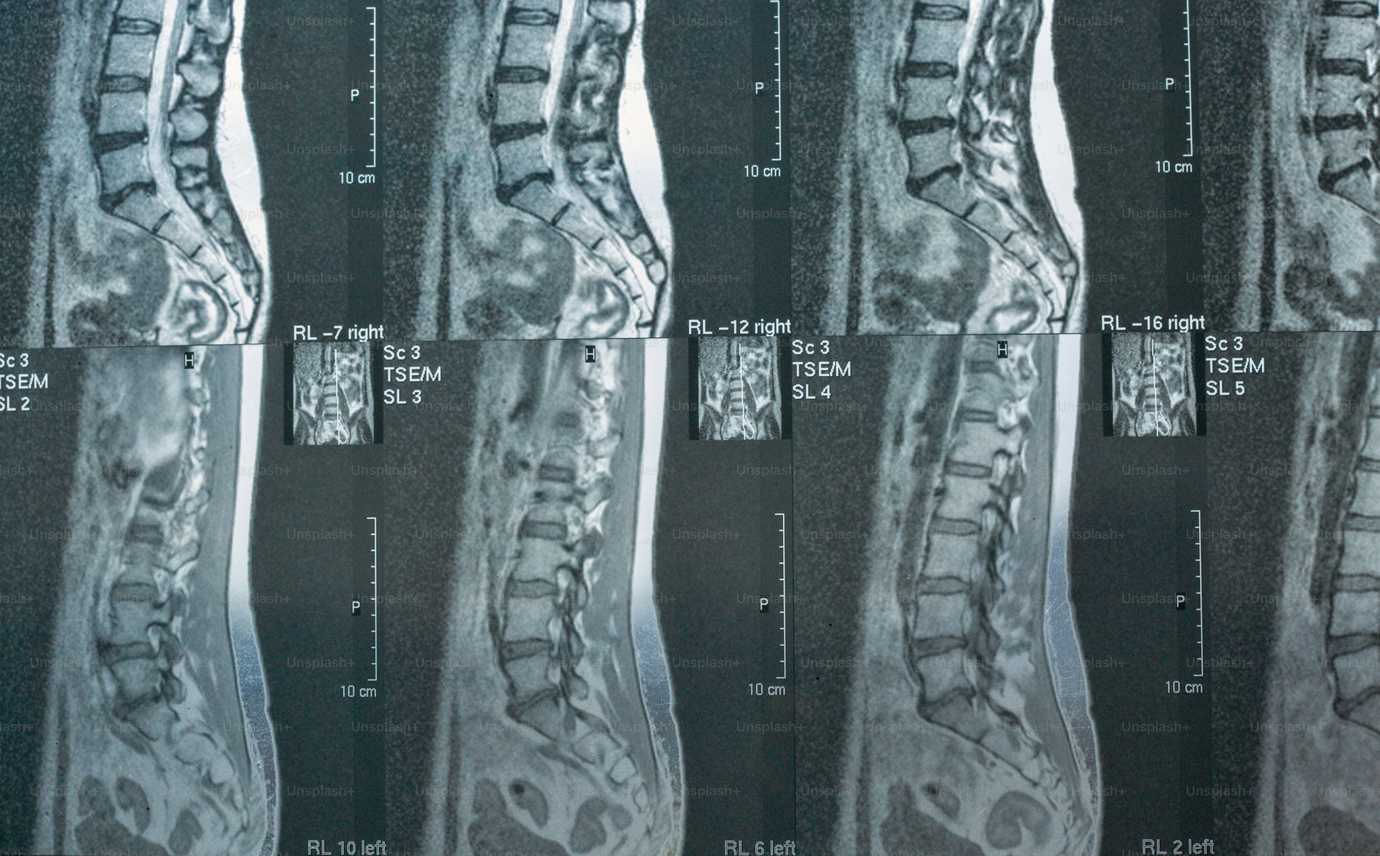 Tomografía computarizada de primer plano de la columna vertebral humana