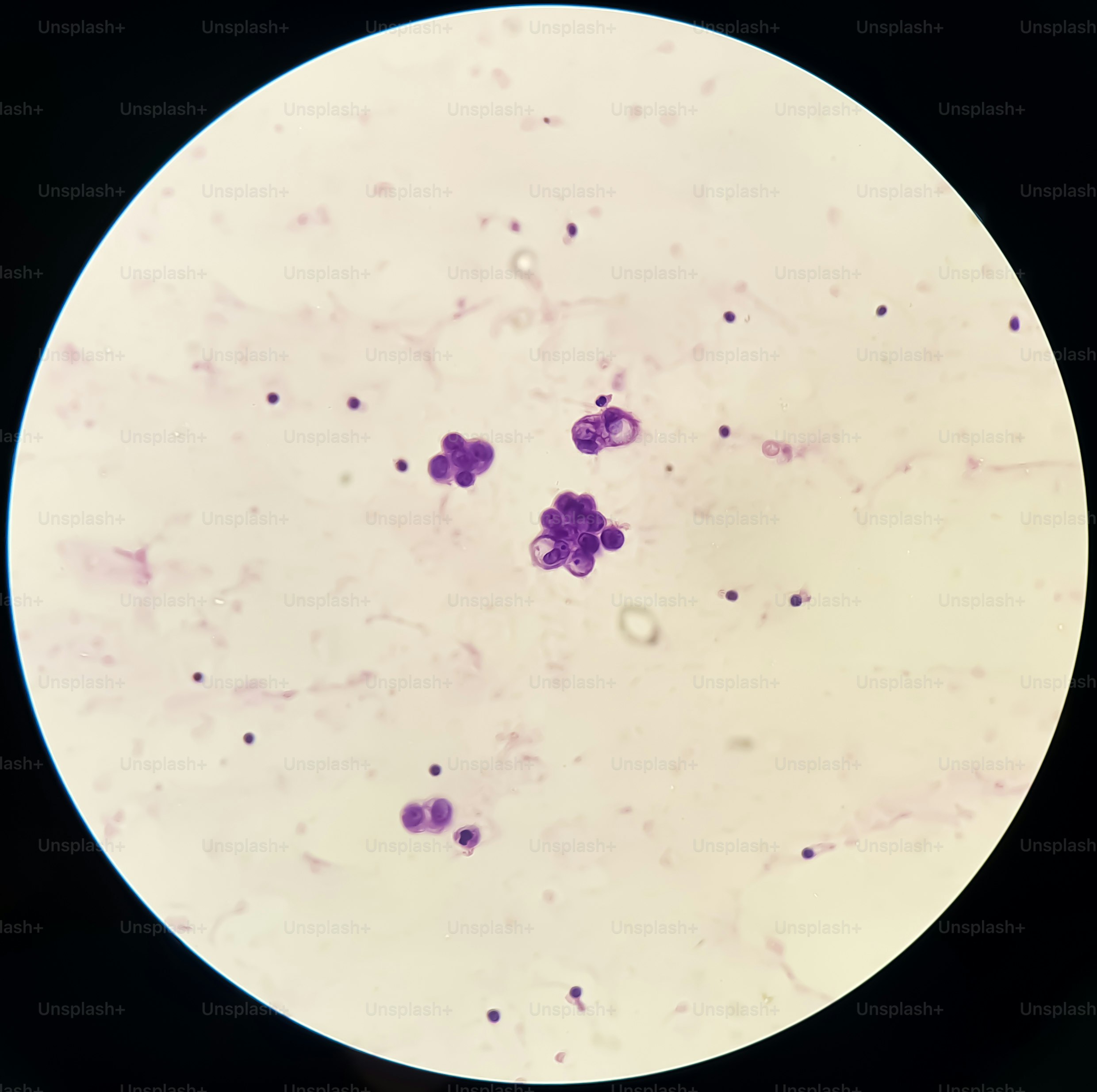 Malignant fluid cytology; Cells of adenocarcinoma may spread to fluid of pleural or peritoneal cavity in cancer from the breast, lung, colon, pancreas, ovary, endometrium or other sites.