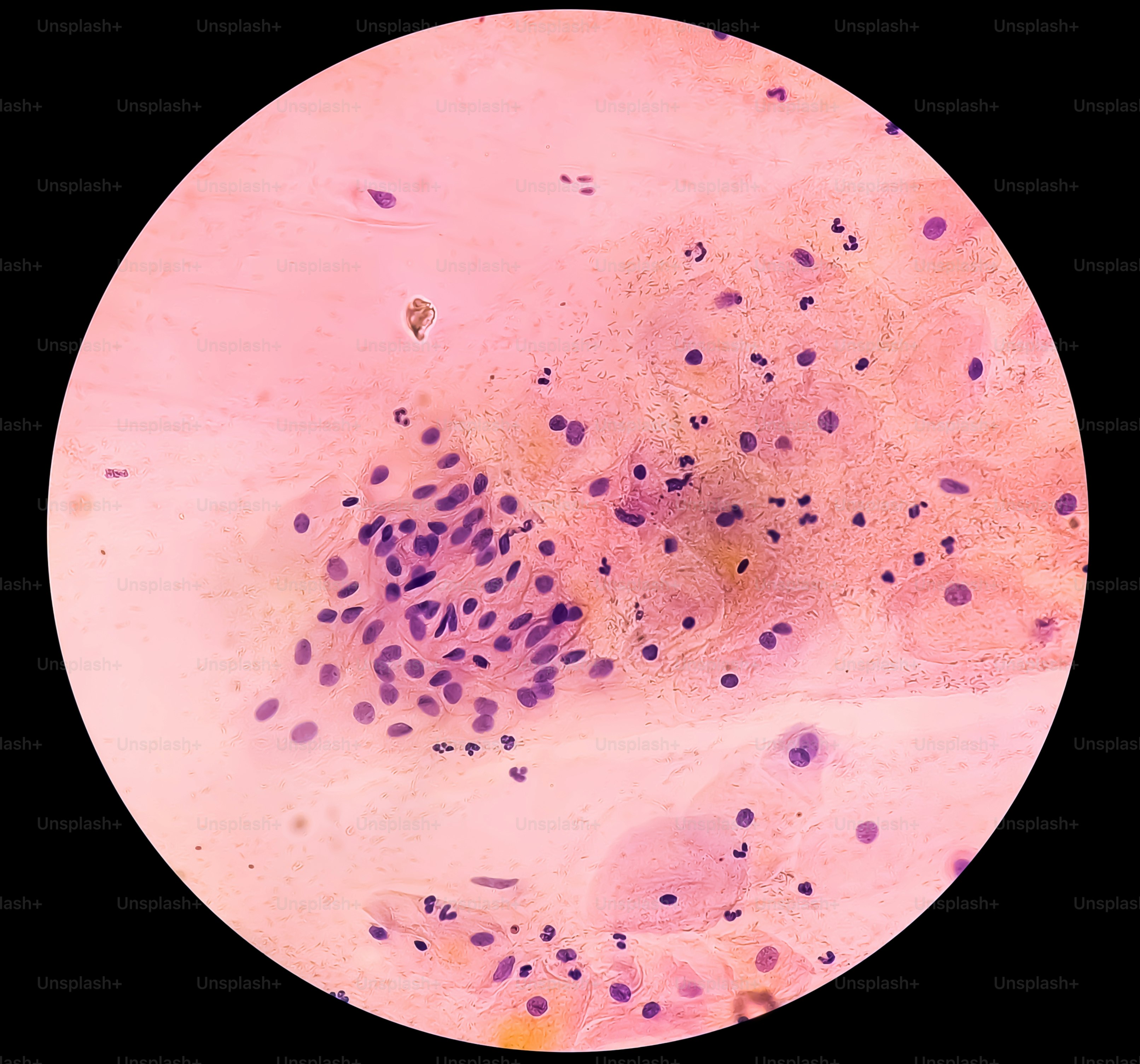Paps smear: NILM with reactive cellular changes associated with inflammation. HPV