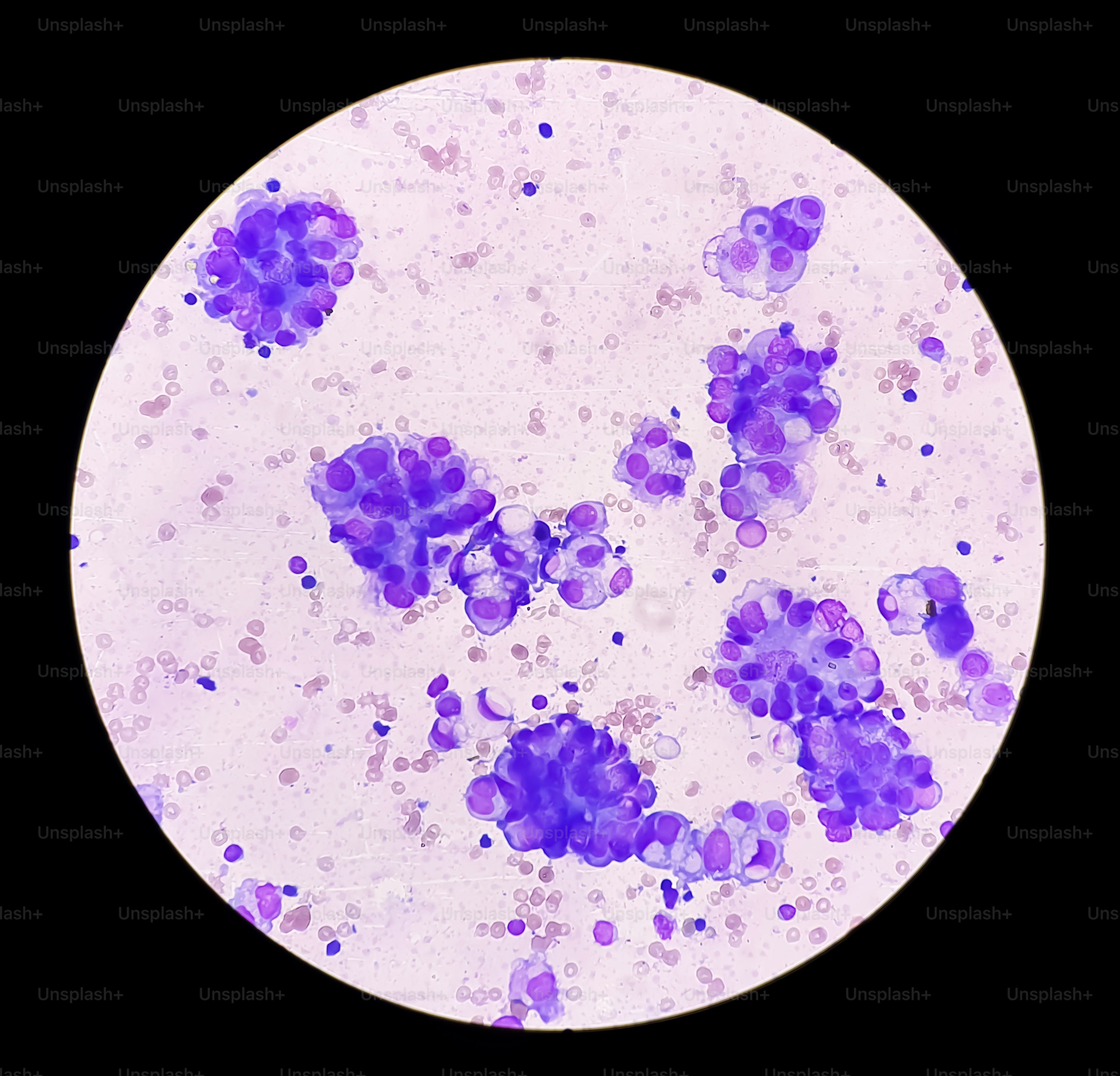 Malignant fluid cytology; Cells of adenocarcinoma may spread to fluid of pleural or peritoneal cavity in cancer from the breast, lung, colon, pancreas, ovary, endometrium or other sites.