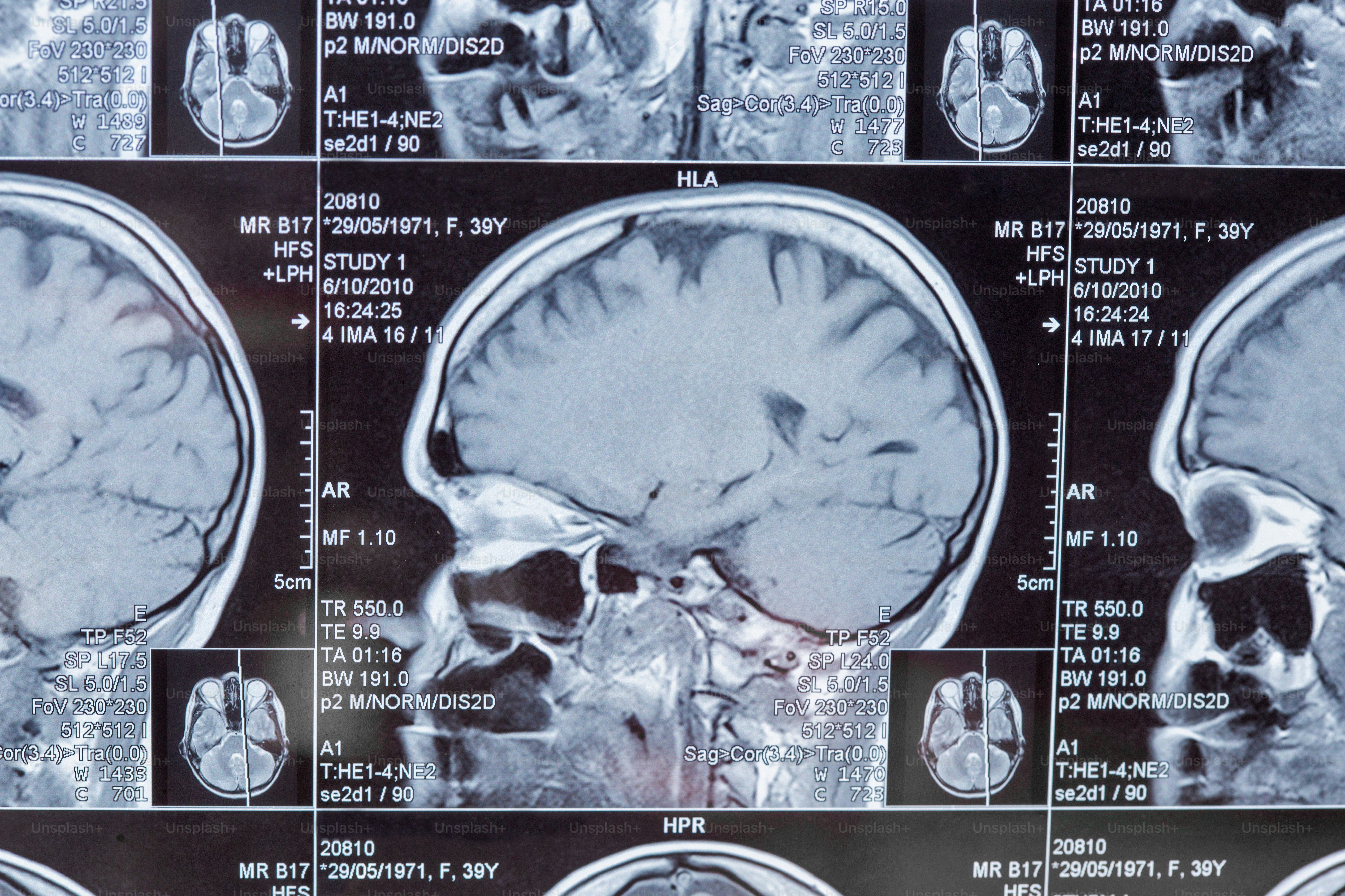 Magnetic resonance imaging or MRI image of the brain closeup