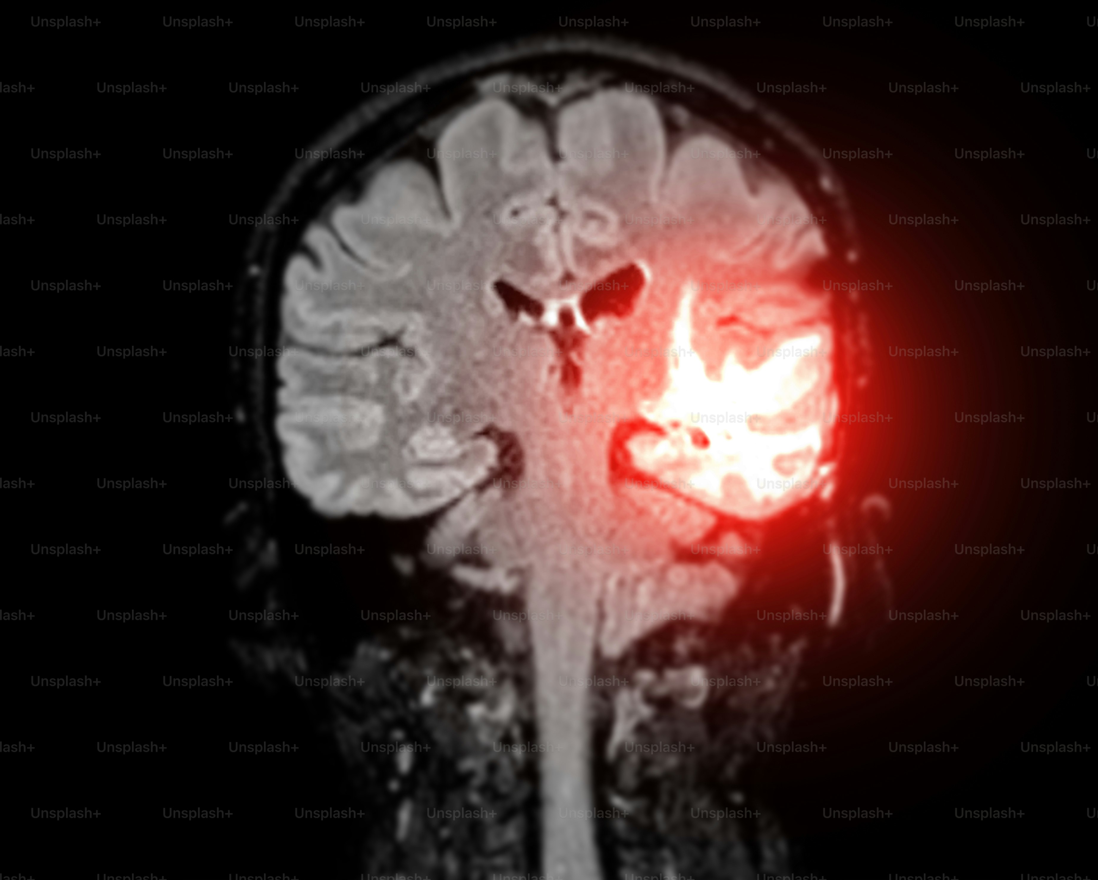 La risonanza magnetica rivela una lesione nell'emisfero sinistro del cervello, fornendo informazioni critiche sulle condizioni del paziente per la diagnosi e la pianificazione del trattamento.