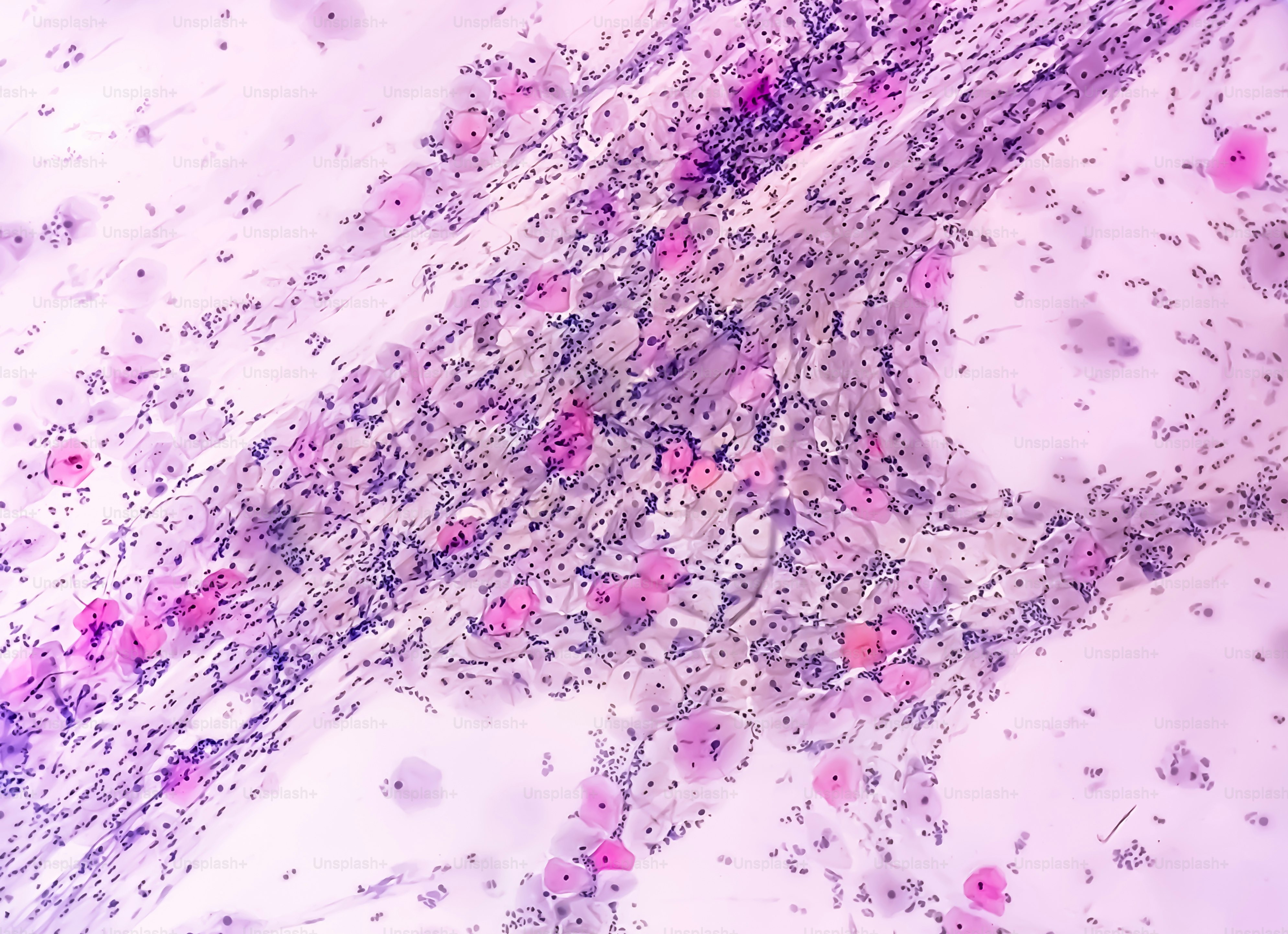 Paps smear: NILM with reactive cellular changes associated with inflammation. HPV