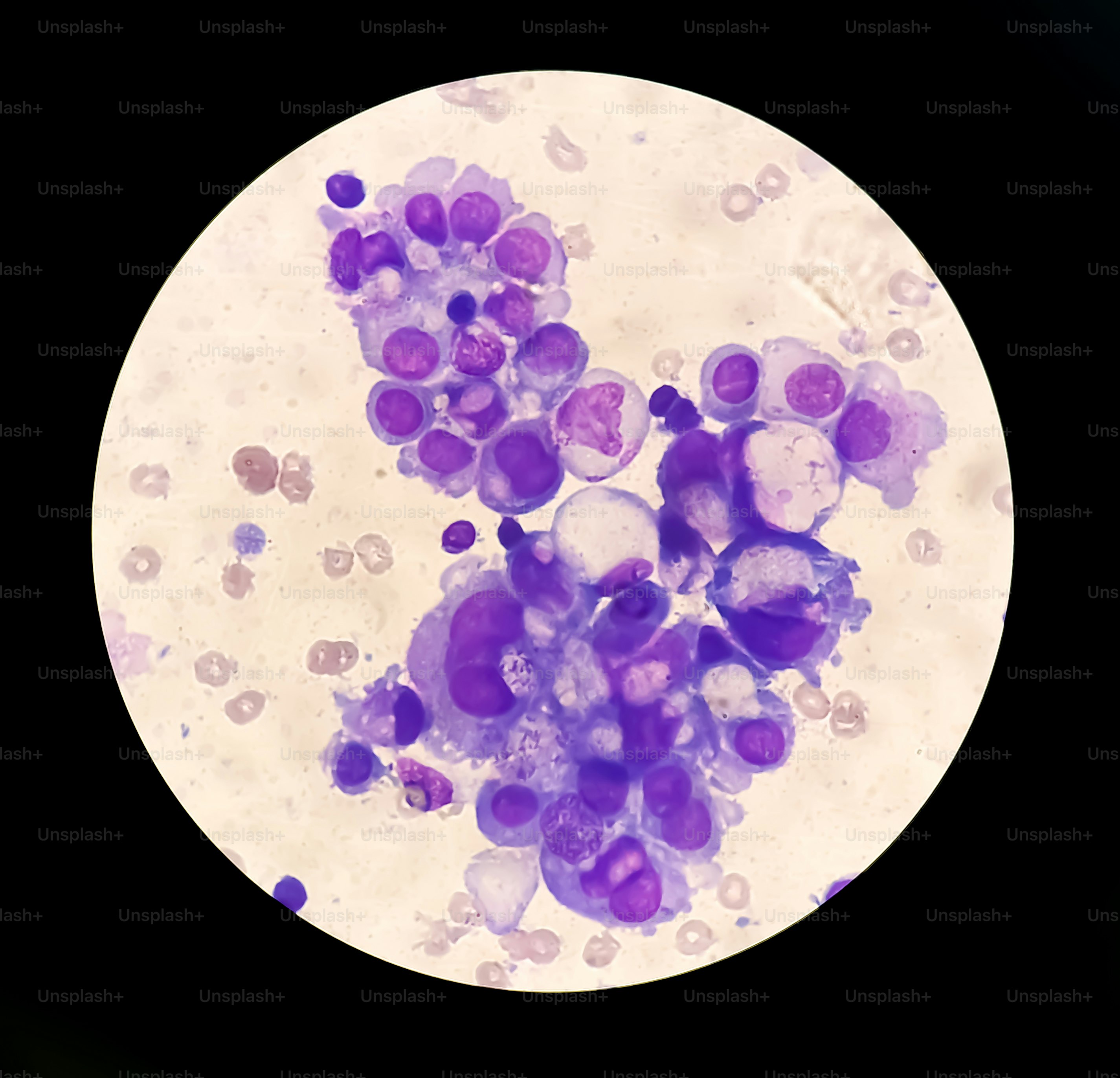 Malignant fluid cytology; Cells of adenocarcinoma may spread to fluid of pleural or peritoneal cavity in cancer from the breast, lung, colon, pancreas, ovary, endometrium or other sites.