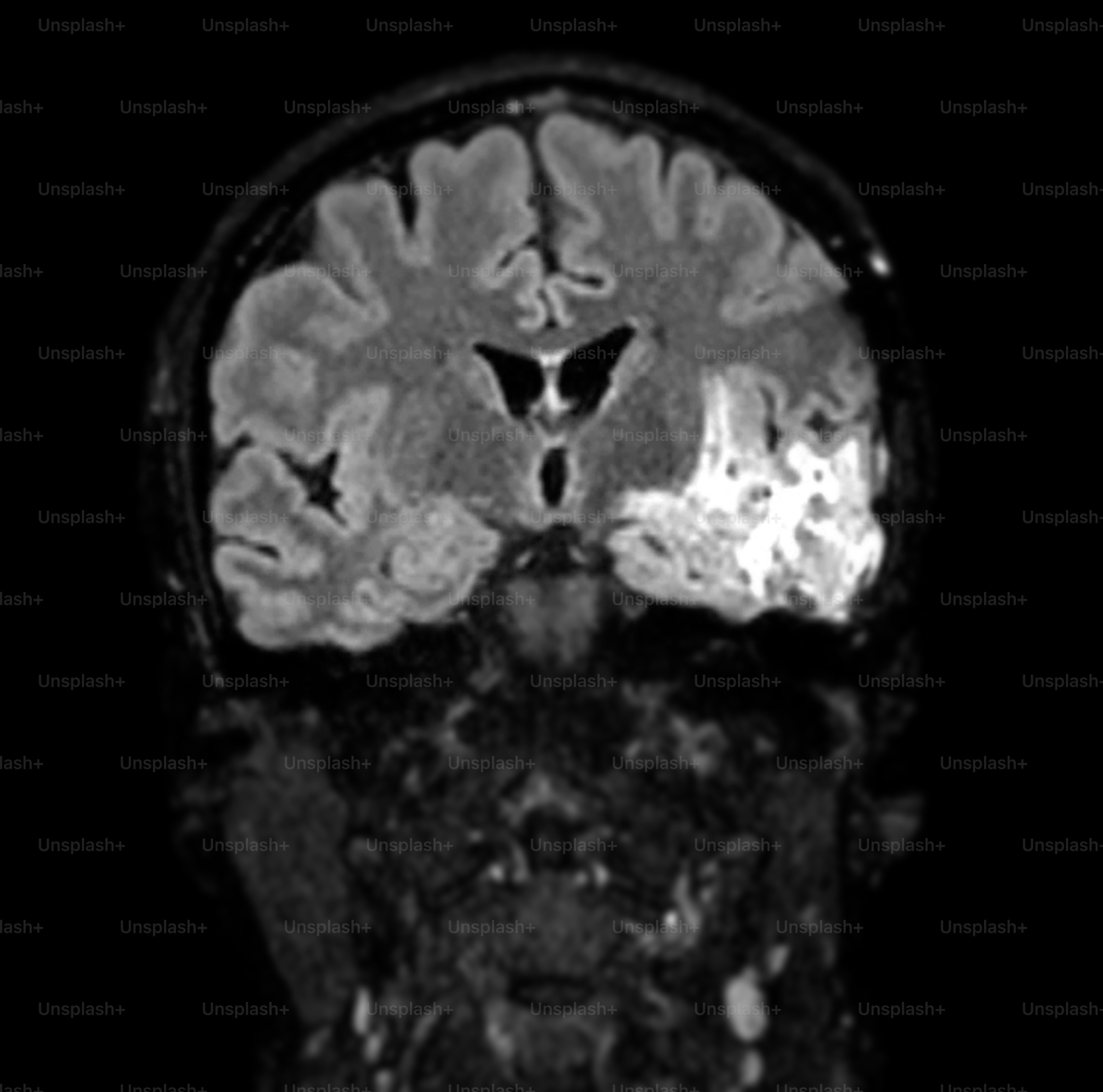 La risonanza magnetica rivela una lesione nell'emisfero sinistro del cervello, fornendo informazioni critiche sulle condizioni del paziente per la diagnosi e la pianificazione del trattamento.
