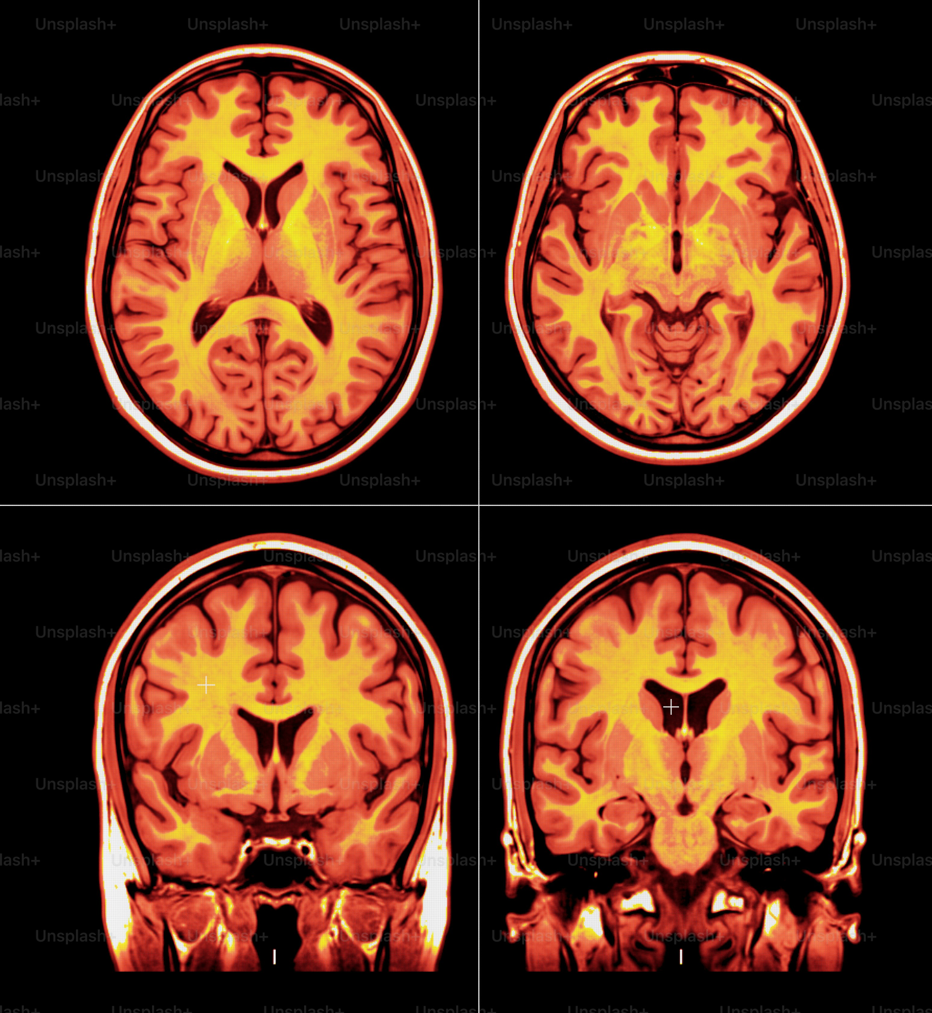 Four colorful mri scans of a human brain. photo – Health Image on Unsplash