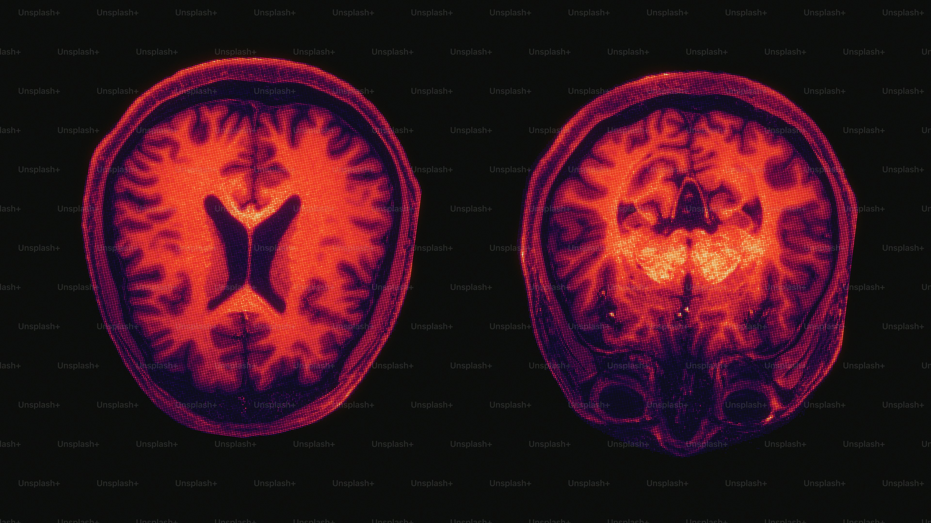 Axial and coronal brain mri scans with vibrant colors. photo – Health ...