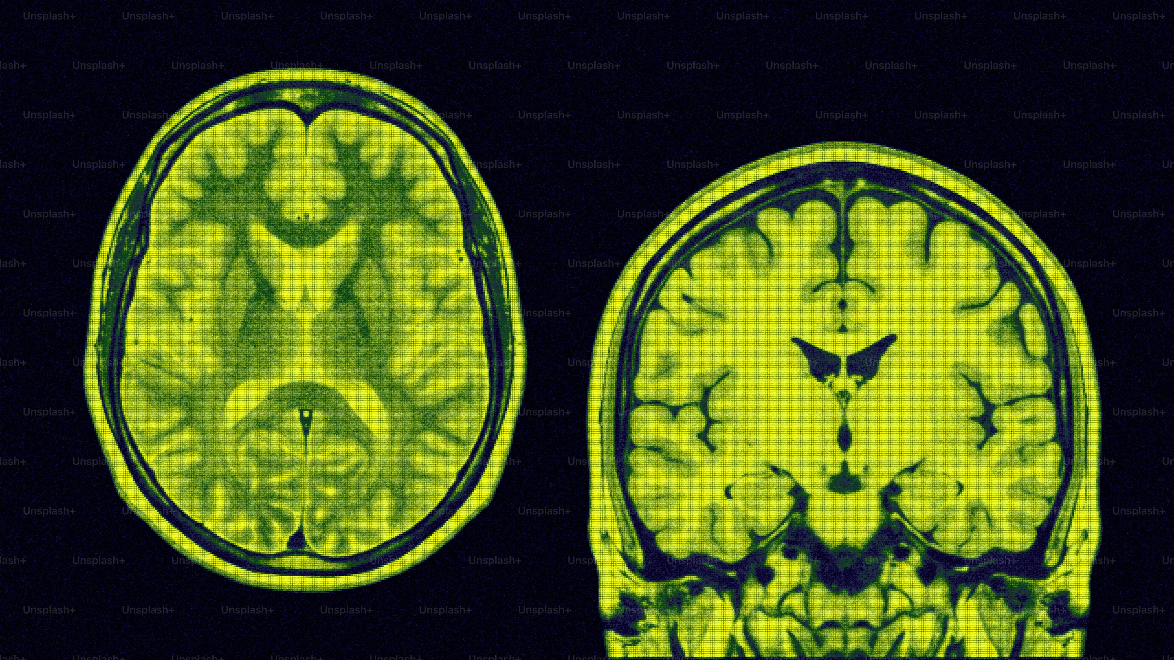 Two yellow-green human brain scans on a dark background.