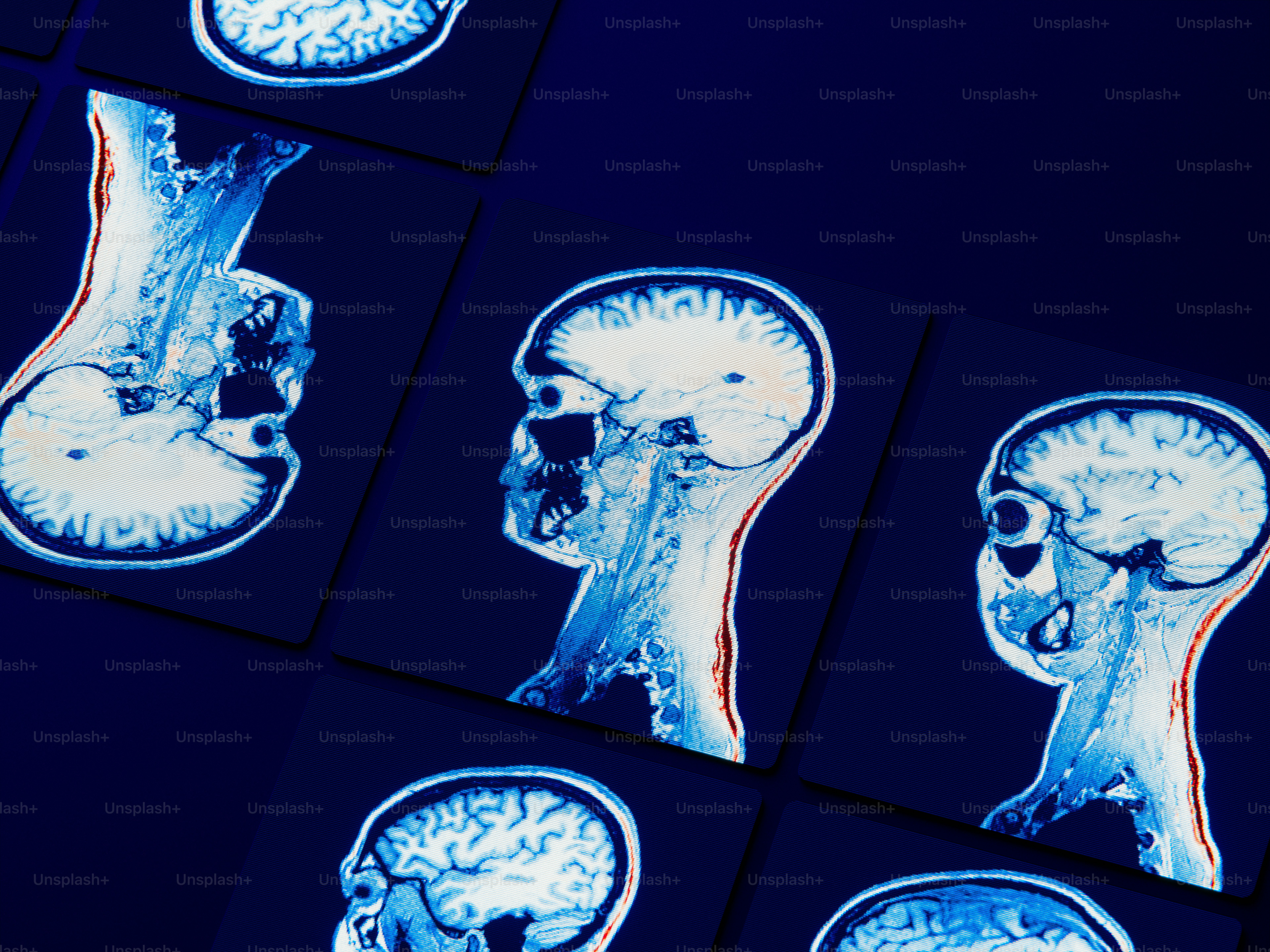 Multiple blue and white mri scans of human heads.