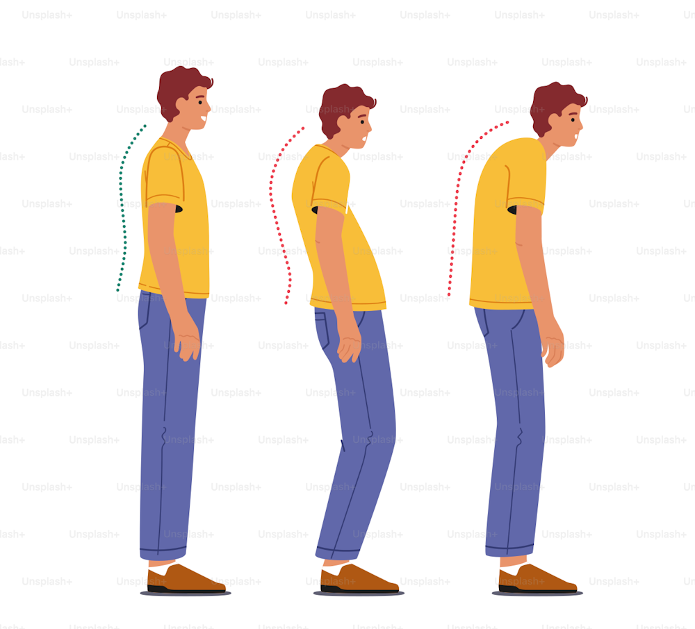 Concepto de escoliosis y curvatura de la columna vertebral. Hombre con postura correcta e incorrecta en comparación con la postura sana y no saludable del hueso de la espalda mala y buena postura. Ilustración vectorial de Cartoon People