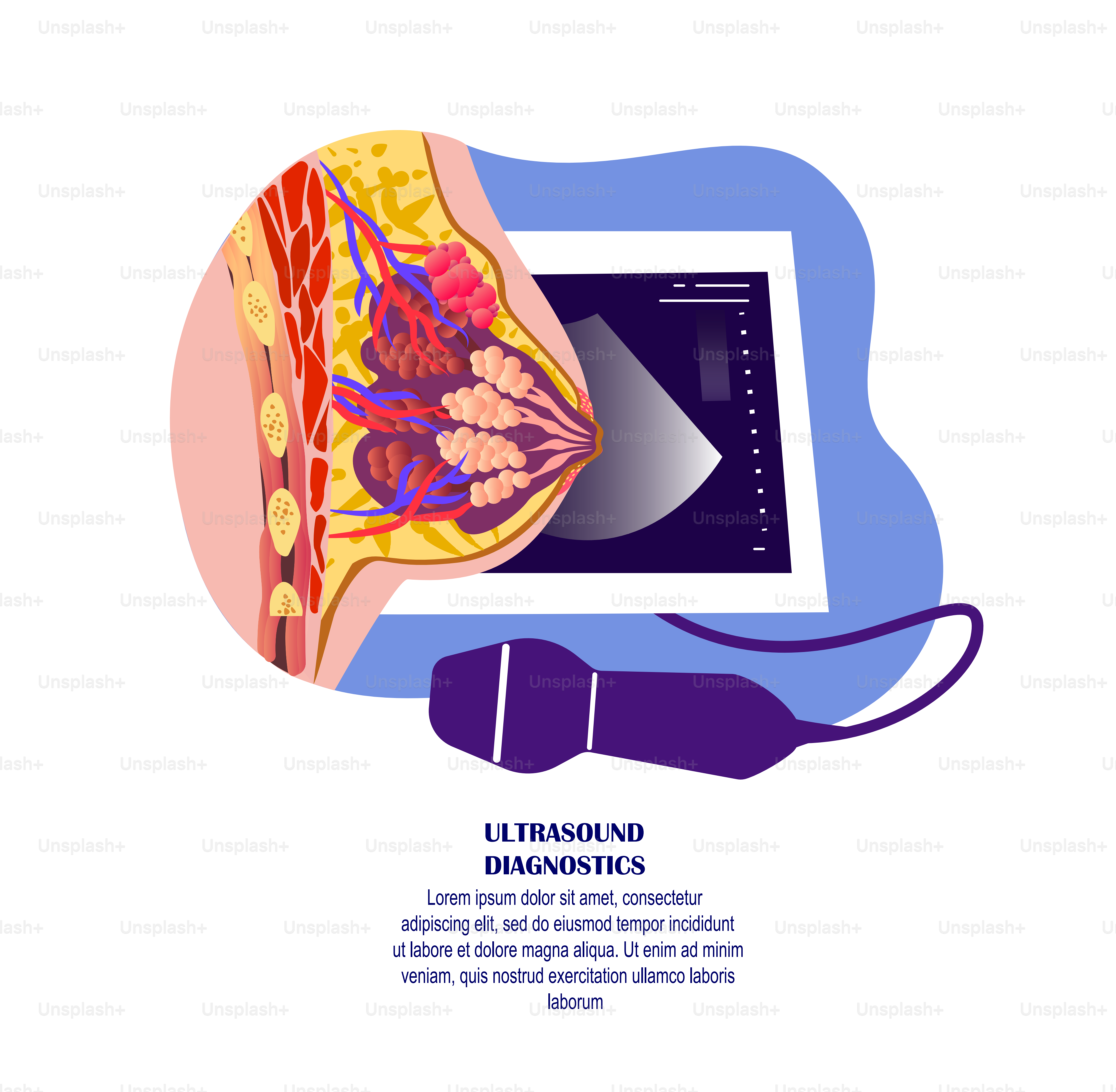 Mammologie, diagnostics par échographie, échographiste, examen de la glande lactée, gonflement du cancer, sein féminin, examen par échographie. Traitement numérique. Recherche sur la guérison féminine. Diagnostic médical à plat