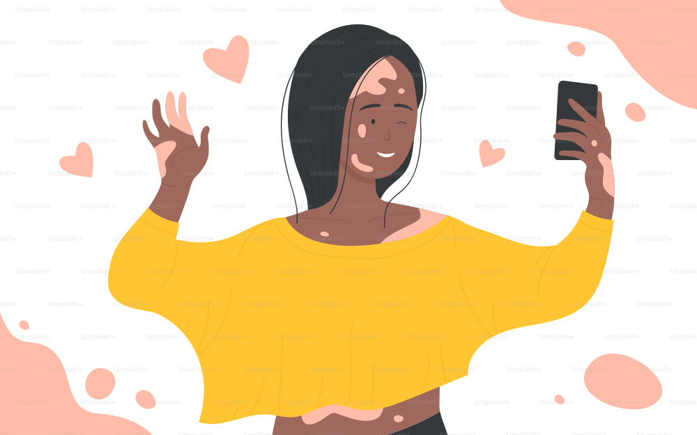 Skin problems vitiligo vector illustration. Cartoon happy girl character using mobile phone to make selfie for social media. Support people with vitiligo, body positive concept