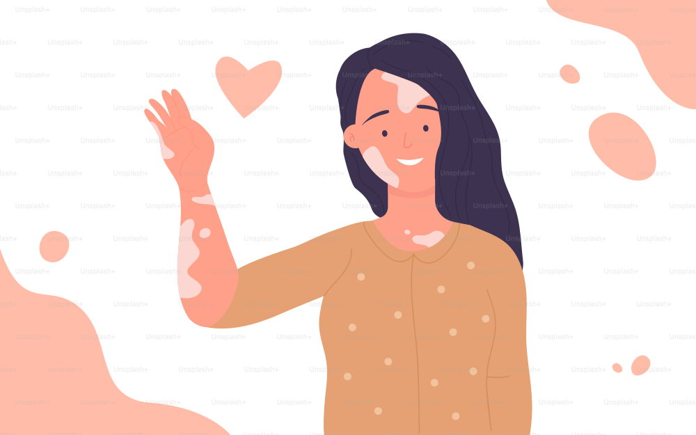 Girl with skin problems vitiligo vector illustration. Cartoon young happy woman character with depigmentation patches smiling, beautiful body positive model waving. International vitiligo day concept