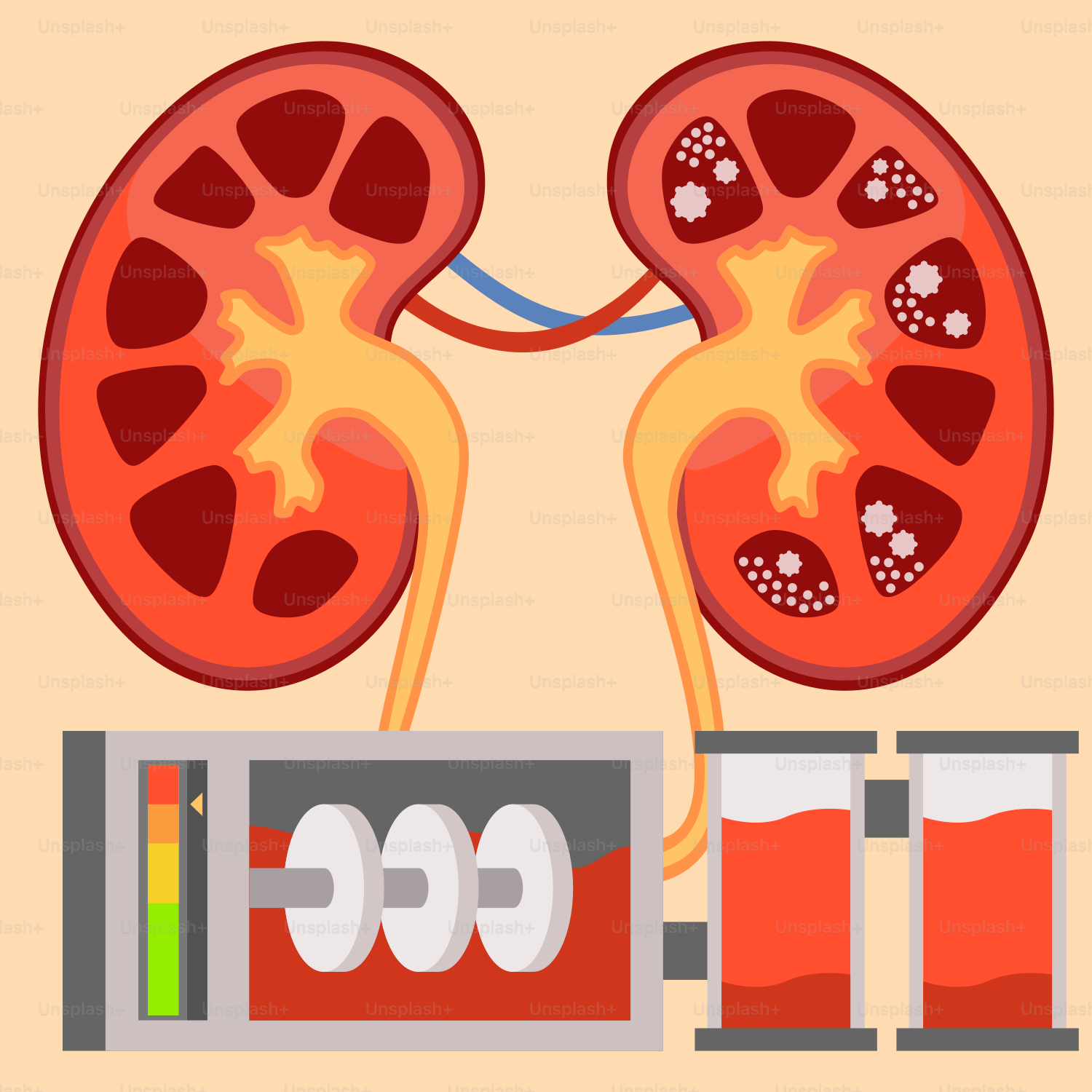 A diagram of a kidney and a blood vessel