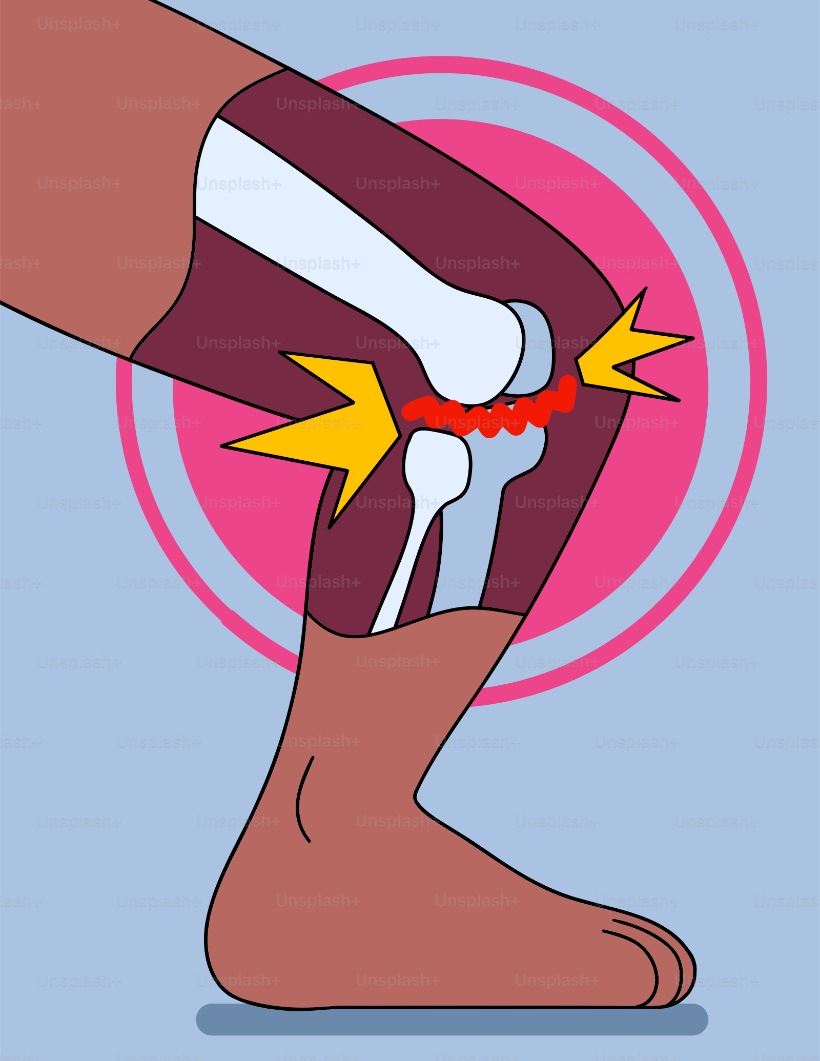 Un pied avec une entorse dessus et une entorse sur le