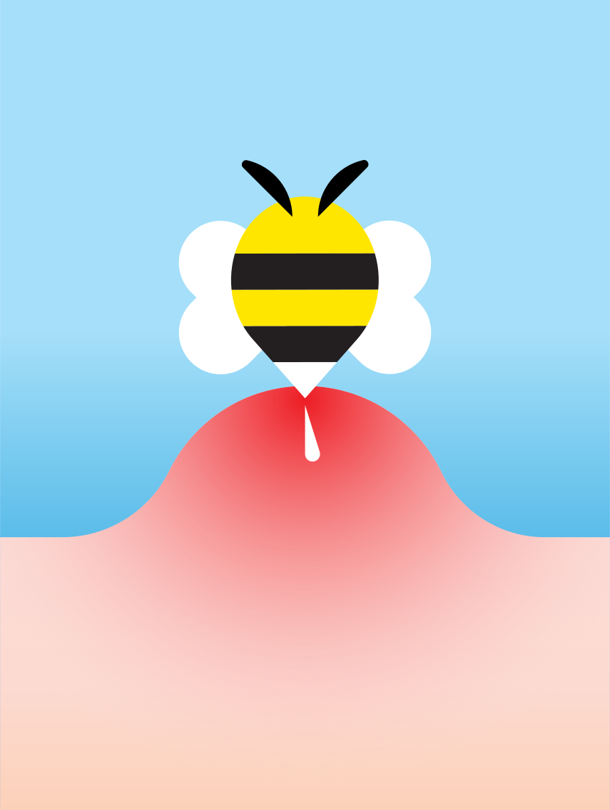 Abeille de dessin animé piquant la peau rouge et enflammée